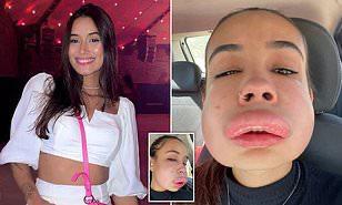 بسبب عمليات التجميل.. فتاة تصاب بتورم شديد في وجهها (فيديو) 
