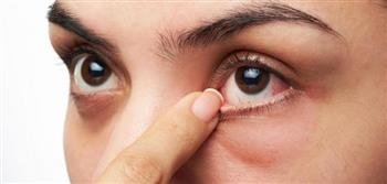  الدكتور‭ ‬تامر‭ ‬فهمي‭: ‬ حساسية‭ ‬العين‭ ‬‭ ‬مرض‭ ‬كل‭ ‬الفصول‭