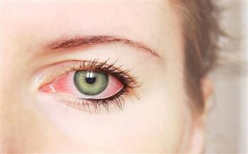 التهاب الملتحمة المعدي بالعين
