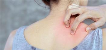 التهاب الجلد التقيحي مرض يصعب تشخيصه