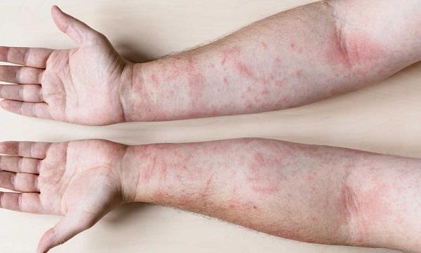 في يومه العالمي.. استشارية توضح أسباب وعلاج  التهاب المفاصل الصدفي
