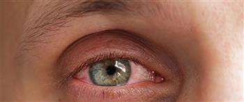 بعض القطرات تسبب الإصابة بحساسية العين