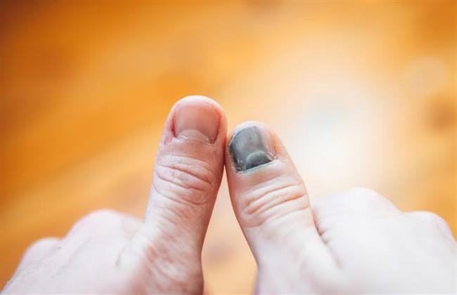 علاج احتباس الدم تحت الأظافر