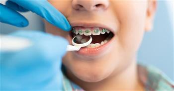 علامات تشير إلى حاجة الطفل لتقويم الأسنان