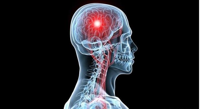 5  أعراض للسكتة الدماغية .. أبرزها صعوبة المشي والكلام