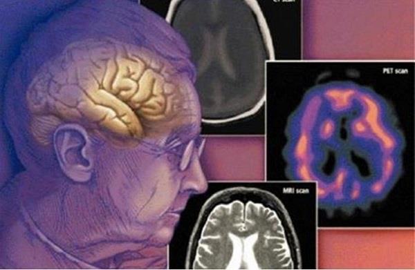 دراسة تحذر: التدخين يؤدي إلى شيخوخة الدماغ