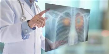 "التدخين" السبب الأول في الإصابة بسرطان الرئة