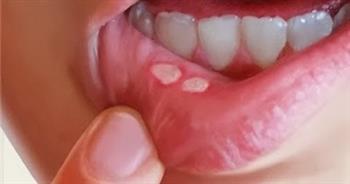 هيئة الدواء تقدم 6 نصائح للتعامل مع قرح الفم