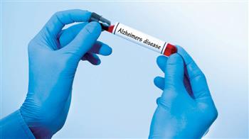 دراسة حديثة : اختبار الدم في منتصف العمر  يتنبأ بمرض الزهايمر 
