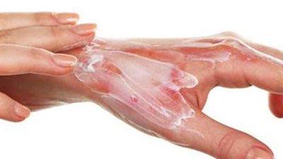 6 نصائح من "هيئة الدواء" للتعامل مع الحروق    