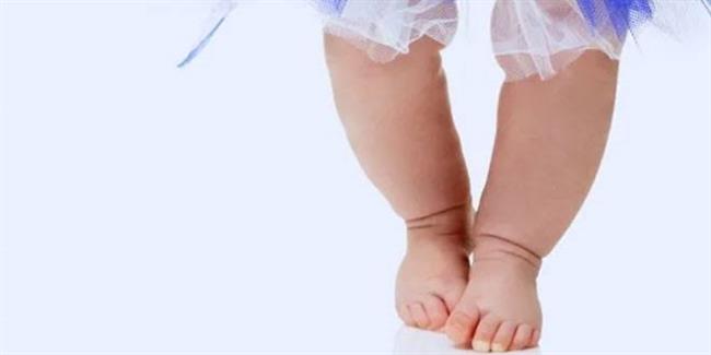 أعراض تقوس الساقين