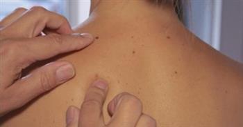 الكشف عن طرق وقاية للحماية من سرطان الجلد