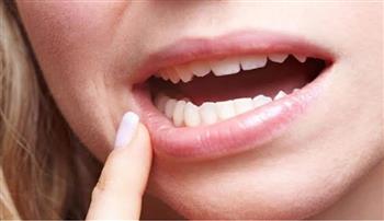 فطريات الفم و والعلاجات المتاحة