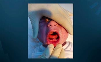 حالة طبية نادرة الحدوث.. ولادة طفل بأسنان لبنية في العراق