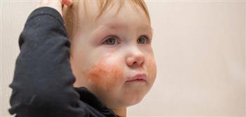 أمراض جلدية تصيب الأطفال في الربيع