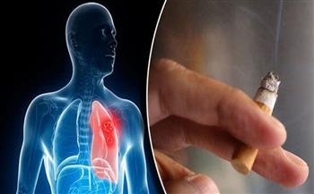 أخصائي أمراض صدرية يكشف مدة التدخين المسببة للانسداد الرئوي المزمن 