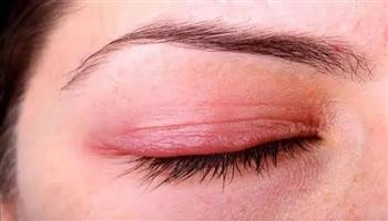 التهاب جفون العين.. الوقاية اهم من العلاج