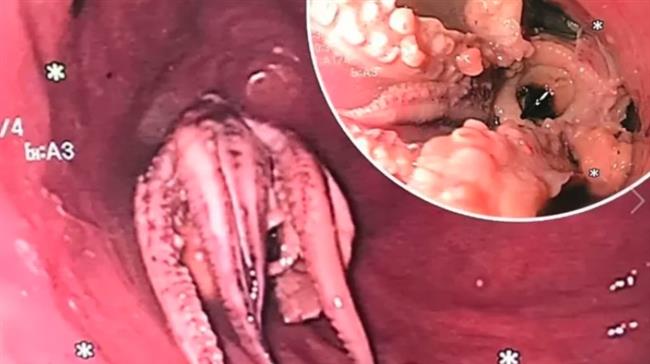رجل يبتلع أخطبوطًا.. والأطباء ينقذون حياته في اللحظات الأخيرة
