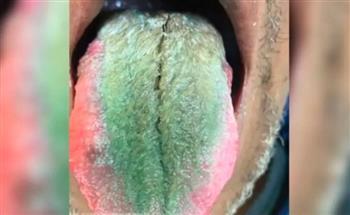 لسبب محرج.. رجل يفاجئ أن لسانه تحوّل إلى اللون الأخضر
