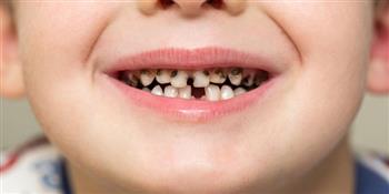 أسنان الأطفال اللبنية تصاب أيضا بالتسوس. .. تعرف على أهم الأسباب