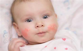 تعرف على اسباب حساسية الجلد لدى الأطفال