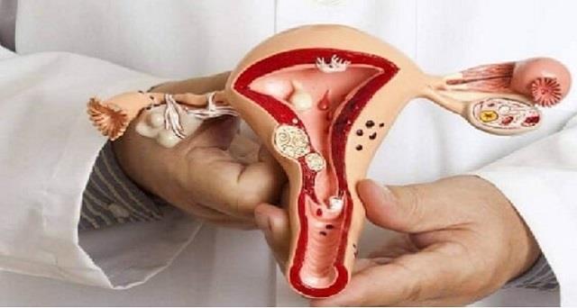 دراسة حديثة تربط بين مشاكل بطانة الرحم والاكتئاب والقلق واضطرابات الأكل