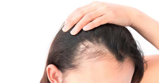 أهم طرق علاج الصلع