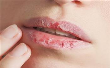أسباب تقشر الشفاة شروخ زوايا الفم في السيدات