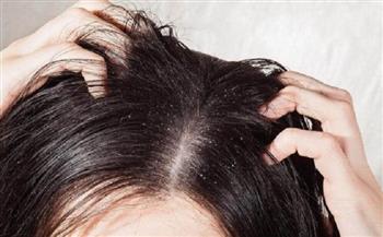 لصحة شعرك.. 5 وصفات طبيعية لتقشير فروة الرأس 