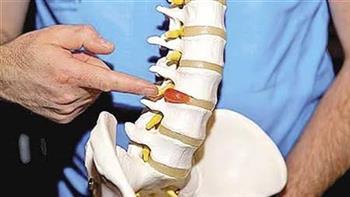كيف يتم علاج الإنزلاق الغضروفي بالجراحة