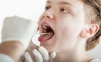 ما هي متلازمة الفم الحارق وما أعراضها؟.. تقرير يوضح