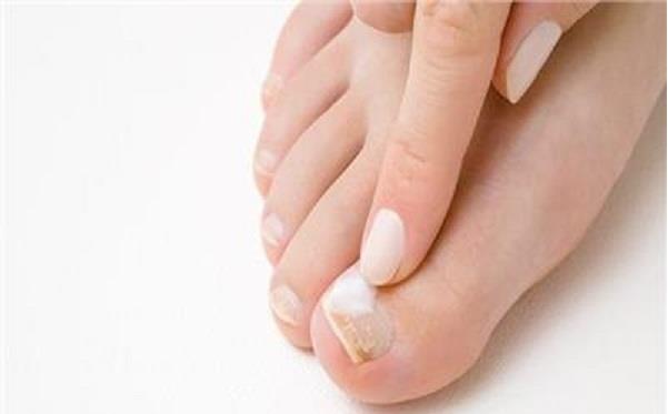 4 حالات تستلزم زيارة الطبيب إذا كنت مصابا بفطريات الأظافر.. تعرف عليها