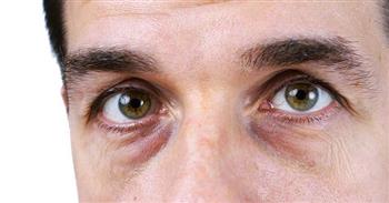 10 أسباب شائعة لظهور الهالات السوداء أسفل العينين