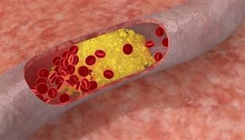 الخميرة تواجه تصلب الشرايين