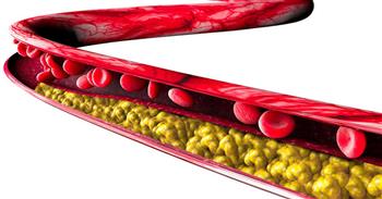 لتقليل نسبة الدهون الثلاثية في الدم .. اتبع الآتي