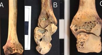 اكتشاف أقدم حالات التهاب المفاصل الروماتويدي في هيكل امرأة عمره 3500 عام