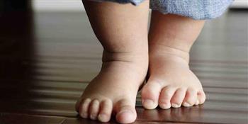 متى يتم التدخل الجراحي لعلاج تقوس الساق لدى الأطفال؟