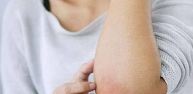 احذروا ... الحساسية قد تؤدي إلي الوفاة