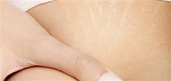 وصفات طبيعية  للتخلص من علامات تمدد الجلد «السترتش مارك»