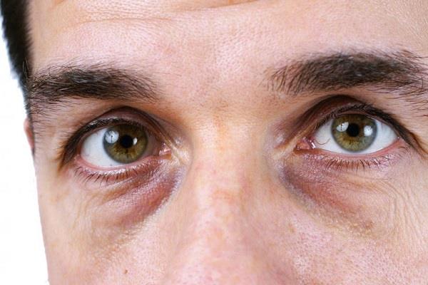 7 أسباب لانتفاخ الجيوب أسفل العينين 