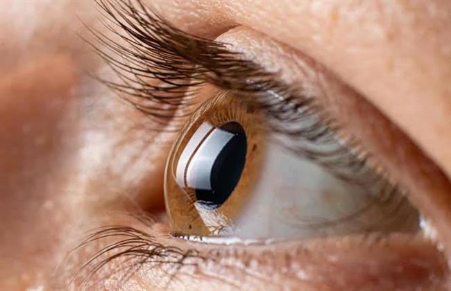تعرف على اسباب القرنية المخروطية