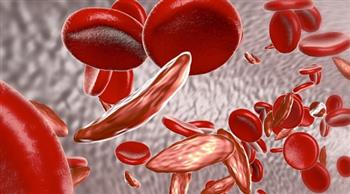 دراسة تكشف مخاطر الكوفيد علي مرضي فقر الدم المنجلي