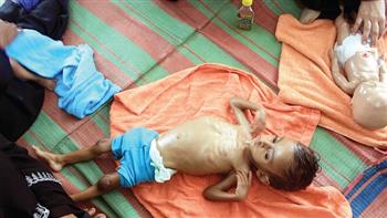 اليونيسف: ملايين الأطفال في اليمن يعانون من سوء التغذية بعد صراع 9 سنوات