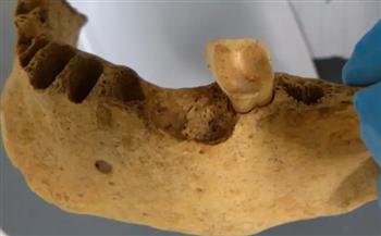 اكتشاف بكتيريا تسوس أسنان عمرها 4000 سنة   