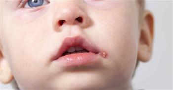 أعراض تدل على إصابة طفلك ب "الهربس"