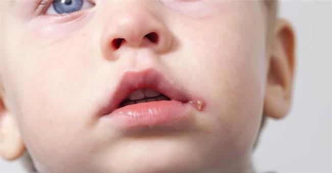 أعراض تدل على إصابة طفلك ب "الهربس"