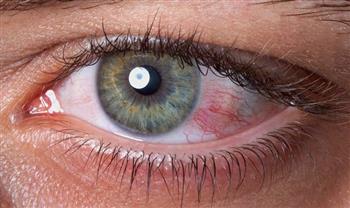 فى حالة جفاف العين.. احذر المواد الحافظة التى تهيج العين !