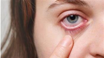 هل تكرار الإصابة بحساسية العين يضعف الإبصار؟