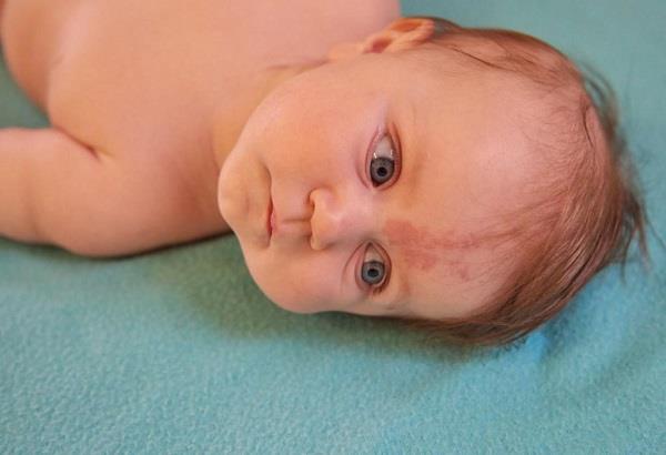 ما هي الوحمة الحمراء عند الرضع وهل تحتاج إلي علاج؟