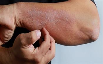نصائح لتجنب التعرض للإصابة بالتهابات الجلد خلال الموجة شديدة الحرارة